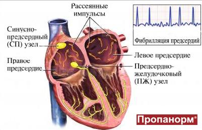 Фибрилляция предсердий